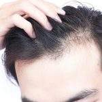 دلایل ریزش مو و درمان راه هایی برای جلوگیری و تقویت موها